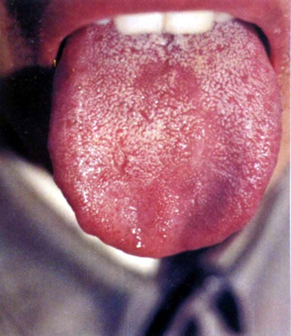 绛色齿痕舌类剥苔